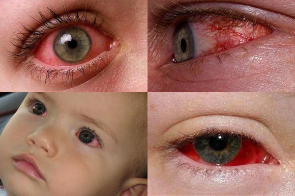Покраснели белки глаз у ребенка, у взрослого: причины, что делать в домашних условиях
