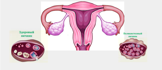 Поликистоз яичников: причины и лечение, прогноз беременности