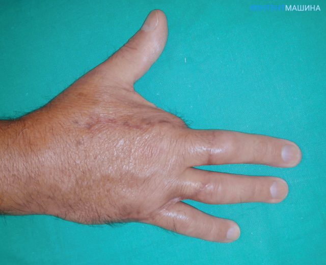Помощь при травматической ампутации конечности: пальца, кисти, руки, стопы