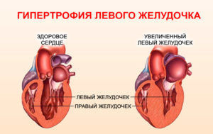 Пороки сердца – что это такое, классификация, причины возникновения, механизм нарушения кровообращения