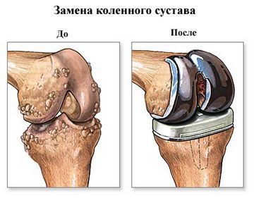 Посттравматический артроз коленного сустава: симптомы, диагностика и методы лечения