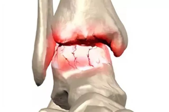 Посттравматический артроз коленного сустава: симптомы, диагностика и методы лечения