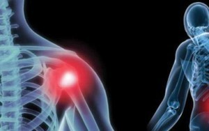 Посттравматический артроз плечевого сустава: степени патологии, характерные симптомы, способы лечения и упражнения для восстановления