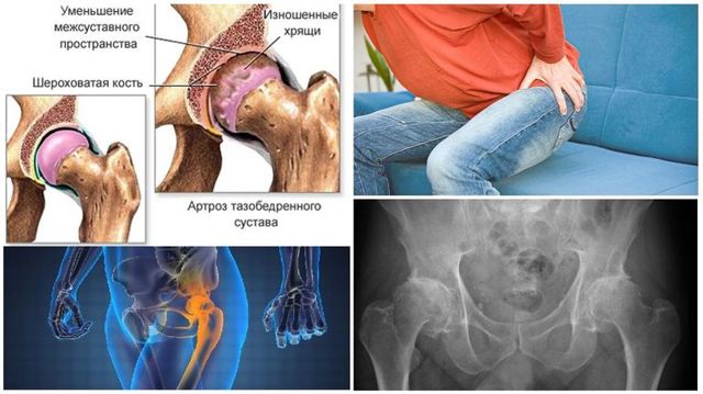 Посттравматический артроз тазобедренного сустава: степени, лечение, инвалидность