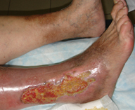 Посттромбофлебитическая болезнь вен нижних конечностей: причины проявления, первые симптомы и профилактика