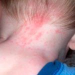 Потница у детей: симптомы и лечение, фото высыпаний на лице и попе