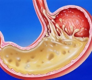 Повышенная кислотность желудка: причины появления, сопутствующие симптомы, способы лечения и принципы диеты