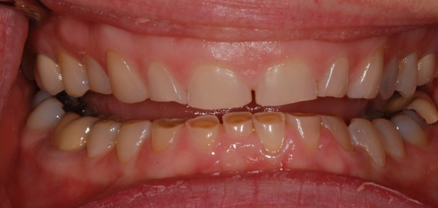 Повышенная стираемость зубов: провоцирующие факторы, характерные проявления, лечебные и профилактические мероприятия
