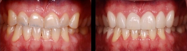 Повышенная стираемость зубов: провоцирующие факторы, характерные проявления, лечебные и профилактические мероприятия