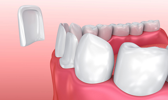 Преимущества и недостатки виниров на зубы: фотографии до и после процедуры