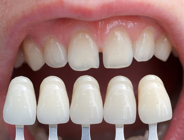 Преимущества и недостатки виниров на зубы: фотографии до и после процедуры
