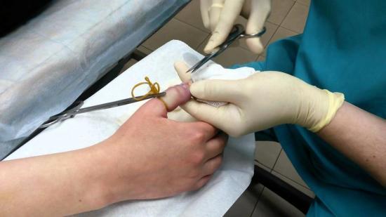 При ногтевой панариции можно пользоваться ихтиоловой мазью: причины воспаления и методы лечения