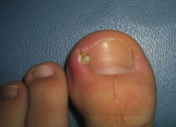 При ногтевой панариции можно пользоваться ихтиоловой мазью: причины воспаления и методы лечения