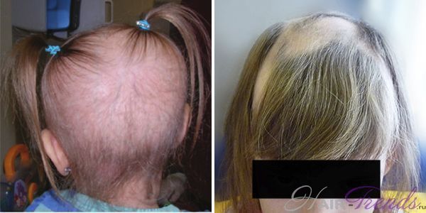 Причина выпадения волос у детей: о чем говорит симптом и как укрепить луковицы и корни