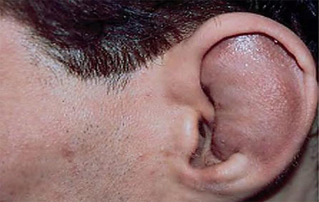 Причины появления отогематома ушной раковины: факторы формирования гематомы ушной раковины