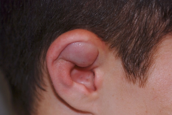 Причины появления отогематома ушной раковины: факторы формирования гематомы ушной раковины