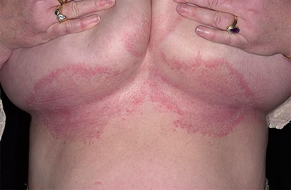 Причины появления сыпи на грудине у женщины в виде прыщиков и потницы