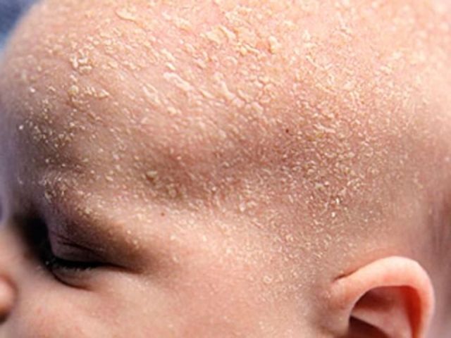 Причины шелушения кожи: что делать, если появилась сухость на лице, на руках, на ногах, лечение