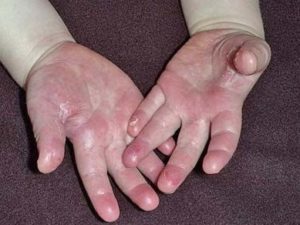 Причины шелушения кожи: что делать, если появилась сухость на лице, на руках, на ногах, лечение