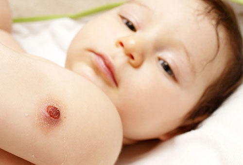 Прививка БЦЖ новорожденному: стоит ли ее делать, возможные осложнения и противопоказания к вакцинации, отзывы врачей и родителей