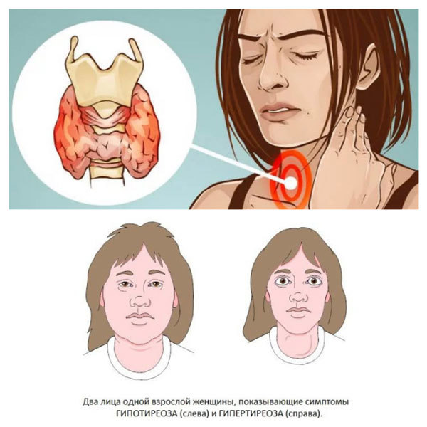 Признаки заболеваний щитовидной железы: перечень распространенных симптомов заболеваний щитовидной железы