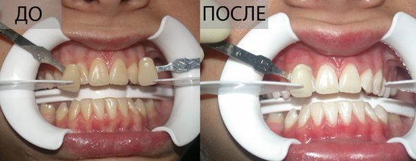 Профессиональное отбеливание зубов системой Beyond Polus: плюсы и минусы, противопоказания