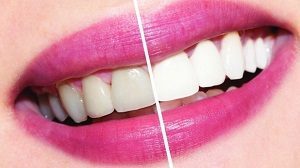 Профессиональное отбеливание зубов системой Beyond Polus: плюсы и минусы, противопоказания
