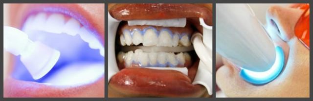 Профессиональное отбеливание зубов: виды, показания, особенности проведения
