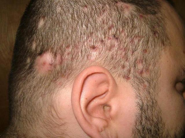 Прыщи на голове в волосах у мужчины: причины возникновения и эффективные методы лечения, фото патологии