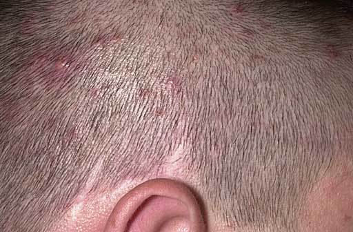Прыщи на голове в волосах у мужчины: причины возникновения и эффективные методы лечения, фото патологии