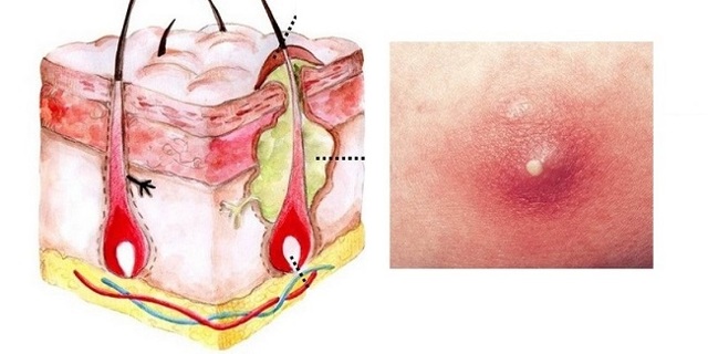 Прыщи на мошонке: причины появления и методы лечения сыпи на интимном органе