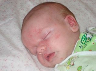 Прыщи у грудничков на лице: причины сыпи у новорожденных, лечение высыпаний у грудничков