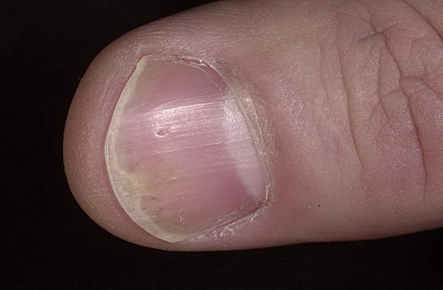 Псориаз ногтей на руках и ногах: причины, фото патологии, эффективные методы лечения