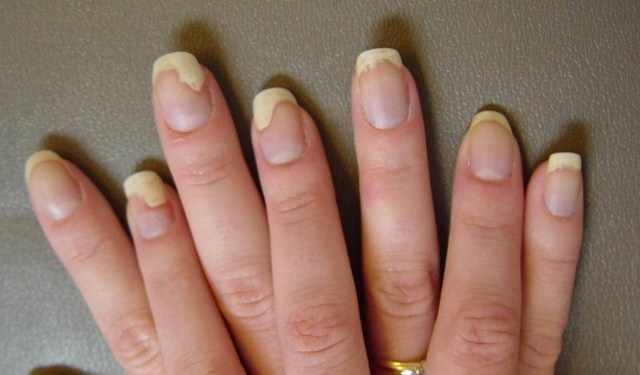 Псориаз ногтей на руках и ногах: причины, фото патологии, эффективные методы лечения