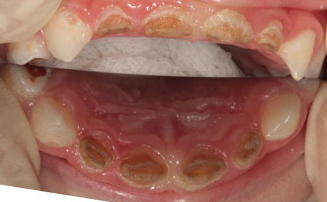 Пульпит молочного зуба: причины развития, клиническая картина, лечебные и профилактические меры