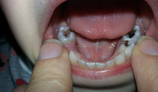 Пульпит молочного зуба: причины развития, клиническая картина, лечебные и профилактические меры
