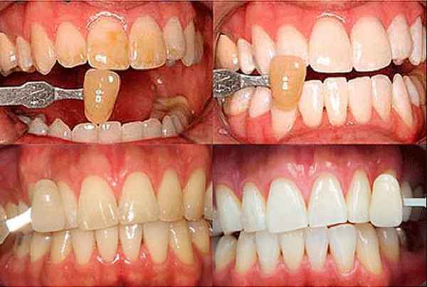 Пятна на зубах — белые, желтые, коричневые, черные: причины появления и эффективные методы лечения