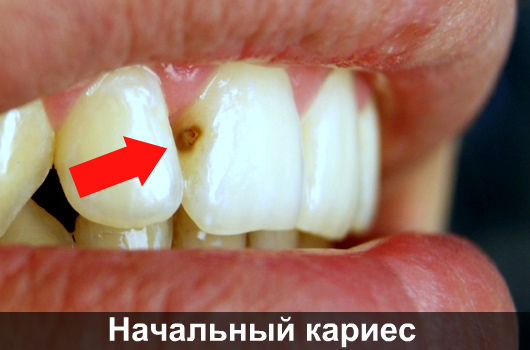 Пятна на зубах — белые, желтые, коричневые, черные: причины появления и эффективные методы лечения