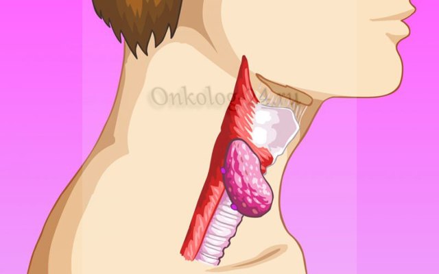 Рак горла: стадии развития, характерные признаки, особенности лечения и прогноз