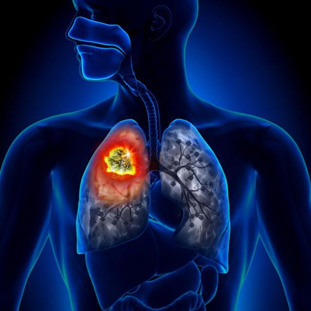 Рак легких: процент выживаемости, срок жизни при разных стадиях, диагностика