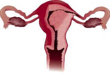Рак матки: факторы риска, стадии развития патологии, принципы лечения и прогноз