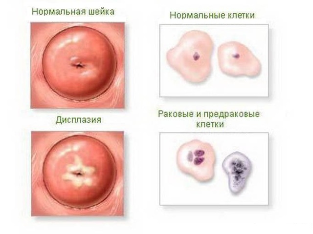 Рак матки: факторы риска, стадии развития патологии, принципы лечения и прогноз
