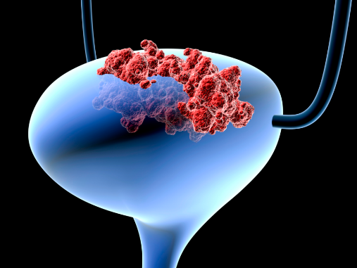 Рак мочевого пузыря: стадии развития, характерные симптомы, методы обследования и лечения