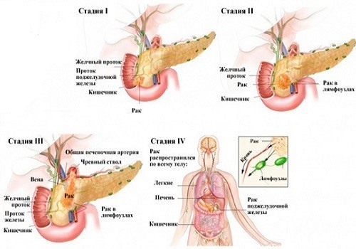 Рак поджелудочной железы: симптомы, лечение, стадии