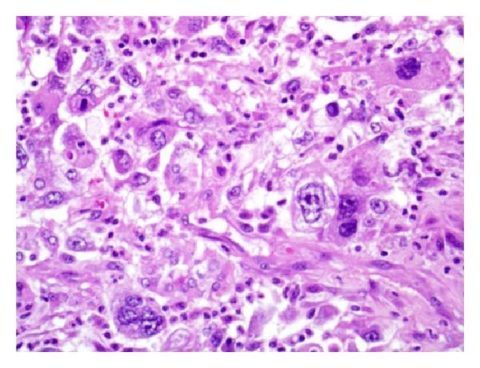 Рак щитовидной железы: классификация видов и причины развития онкологии, разнообразие диагностических процедур в борьбе с болезнью