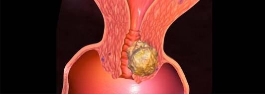 Рак шейки матки: причины, симптомы и стадии болезни