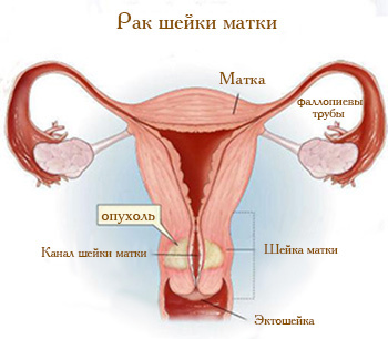 Рак шейки матки: причины, симптомы и стадии болезни