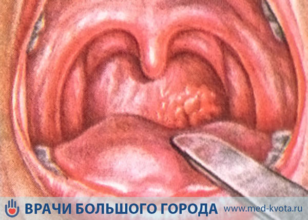 Рак слизистой оболочки полости рта и ротоглотки: первые симптомы и лечение