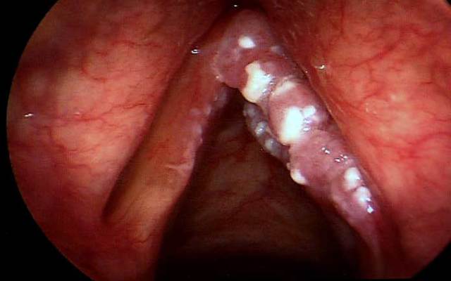 Рак слизистой оболочки полости рта и ротоглотки: первые симптомы и лечение
