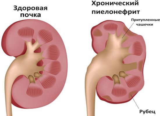 Расшифровка анализа крови и мочи по Нечипоренко: что означают результаты, таблица показателей